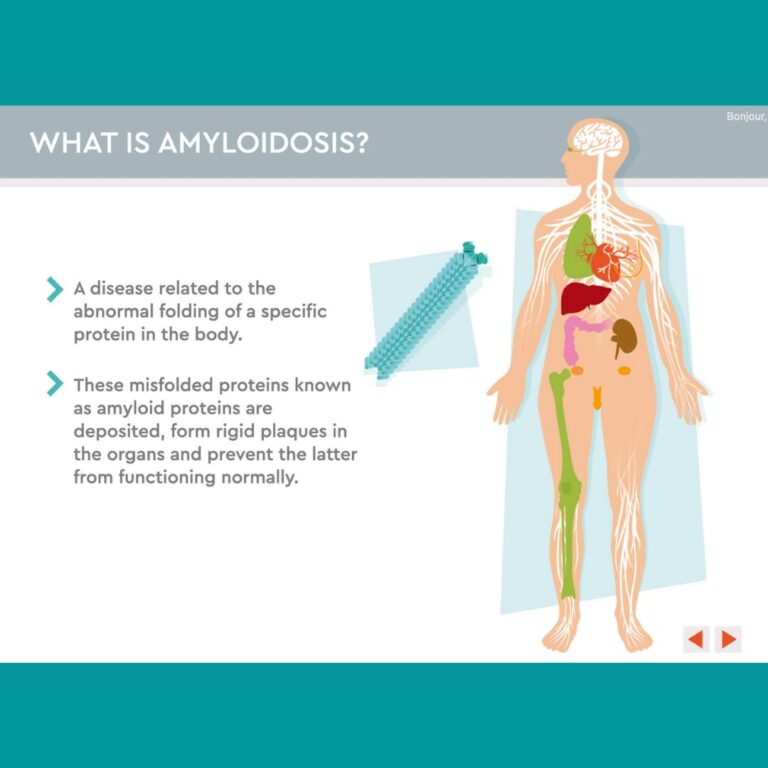 Test your knowledge about Amyloidosis - Amyloidosis Alliance